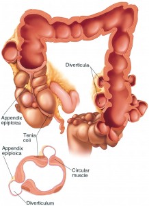 Diverticulos del colon