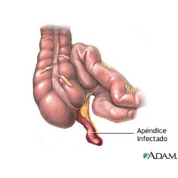 apendicitis