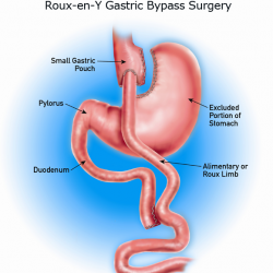 bypass gastrico