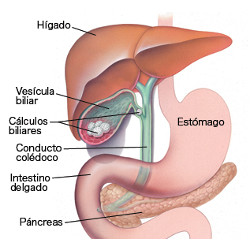 CIRUGÍA DE CÁLCULOS O PIEDRAS LA VESÍCULA EN GUATEMALA - Cirugía Especializada