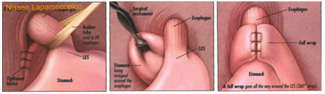 cirugia de reflujo esofagico