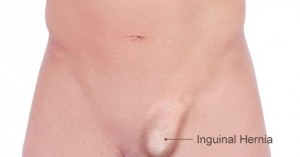 hernia inguinal (2)