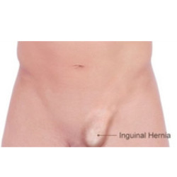 hernia